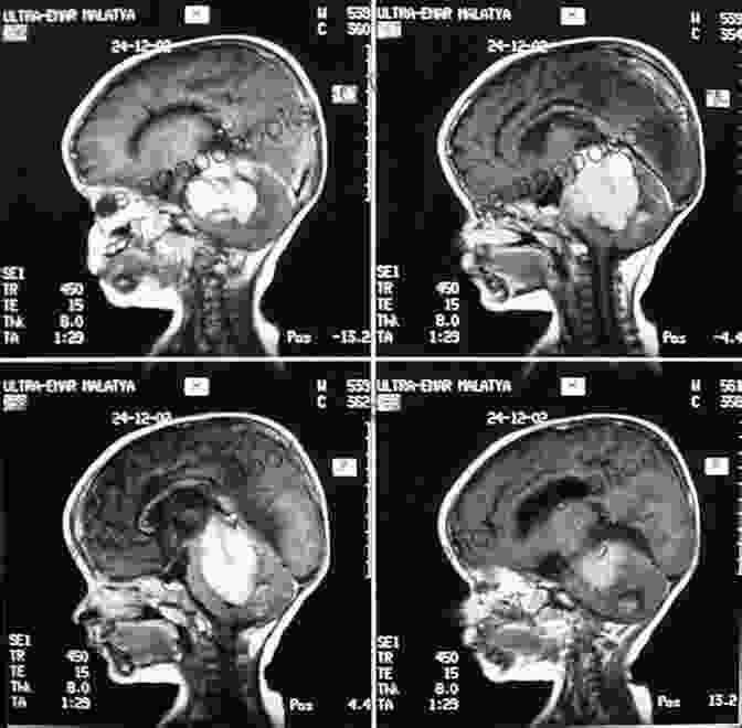 A Photo Of A Child With A Posterior Fossa Tumor Posterior Fossa Tumors In Children