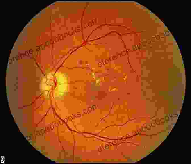 Fundus Photograph Of A Diabetic Retinopathy Cornea: Color Atlas Synopsis Of Clinical Ophthalmology (Wills Eye Hospital Series) (Color Atlas Of Synopsis Of Clinical Ophthalmology)