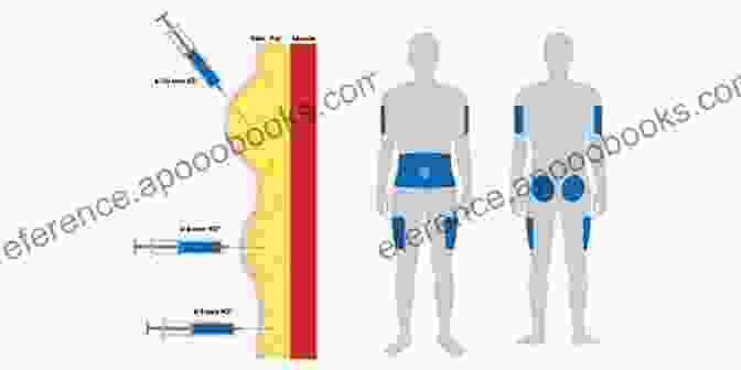 Illustration Of Injection Fundamentals Joint And Soft Tissue Injection: Injecting With Confidence 5th Edition