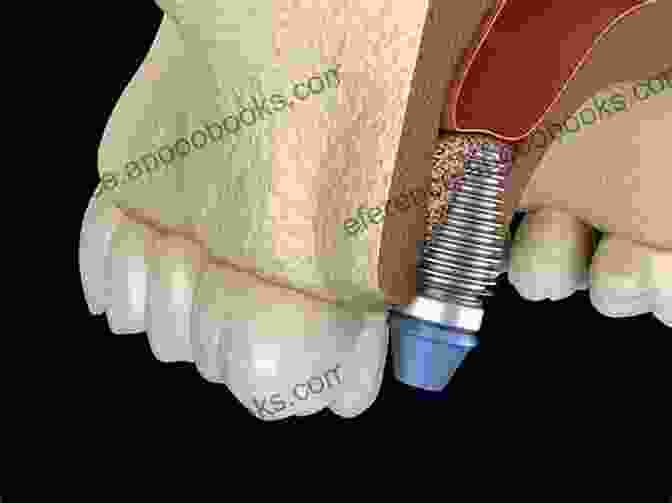 Image Of A Biomaterial Being Applied To A Bone Graft Innovative Perspectives In Oral And Maxillofacial Surgery