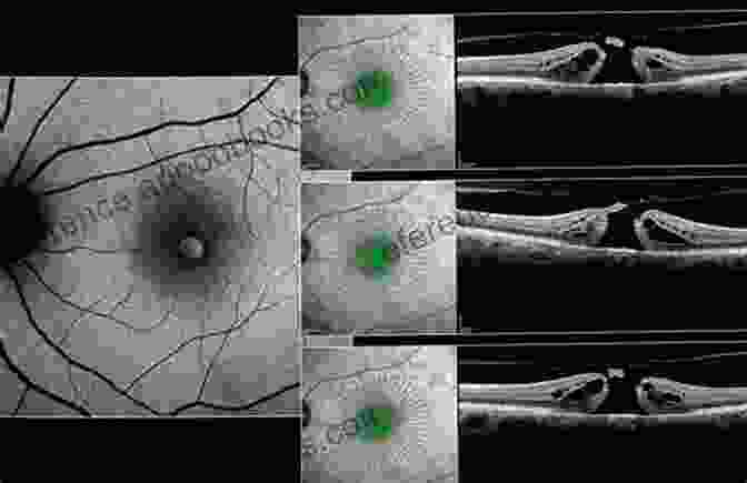 OCT Scan Of A Macular Hole Cornea: Color Atlas Synopsis Of Clinical Ophthalmology (Wills Eye Hospital Series) (Color Atlas Of Synopsis Of Clinical Ophthalmology)