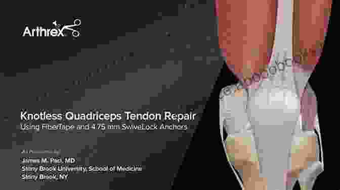 Tendon Repair And Reconstruction Management Of Complications In Common Hand And Wrist Procedures: FESSH Instructional Course 2024