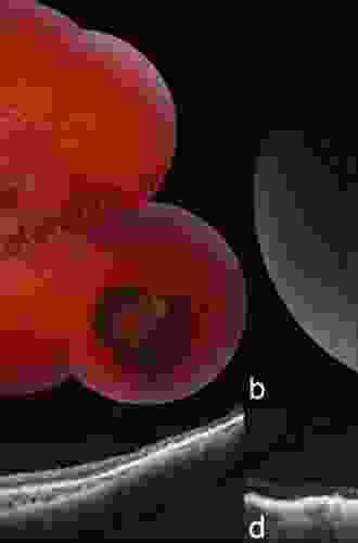 Retinal Pigment Epithelium in Health and Disease